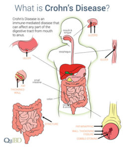 Symptoms of Crohn’s Disease