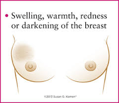 Advances in Breast Cancer